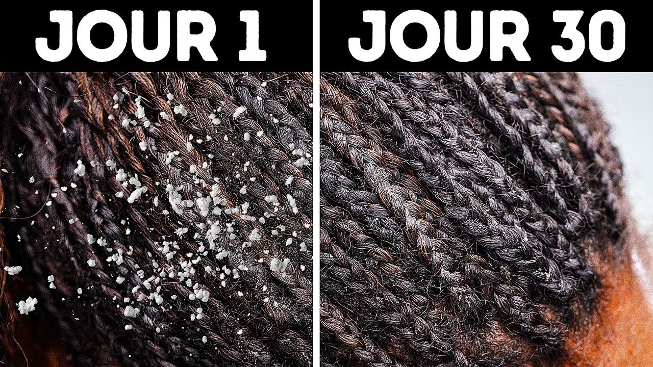 10+ Solutions Naturelles Pour Se Débarrasser Des Pellicules Rapidement À La Maison